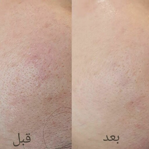 طراحی مدرن و ساده میکرودرم HY9